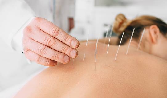 Scalp acupuncture therapy for stroke rehabilitation at Pinnacle of Wholeness Clinic in Nigeria.