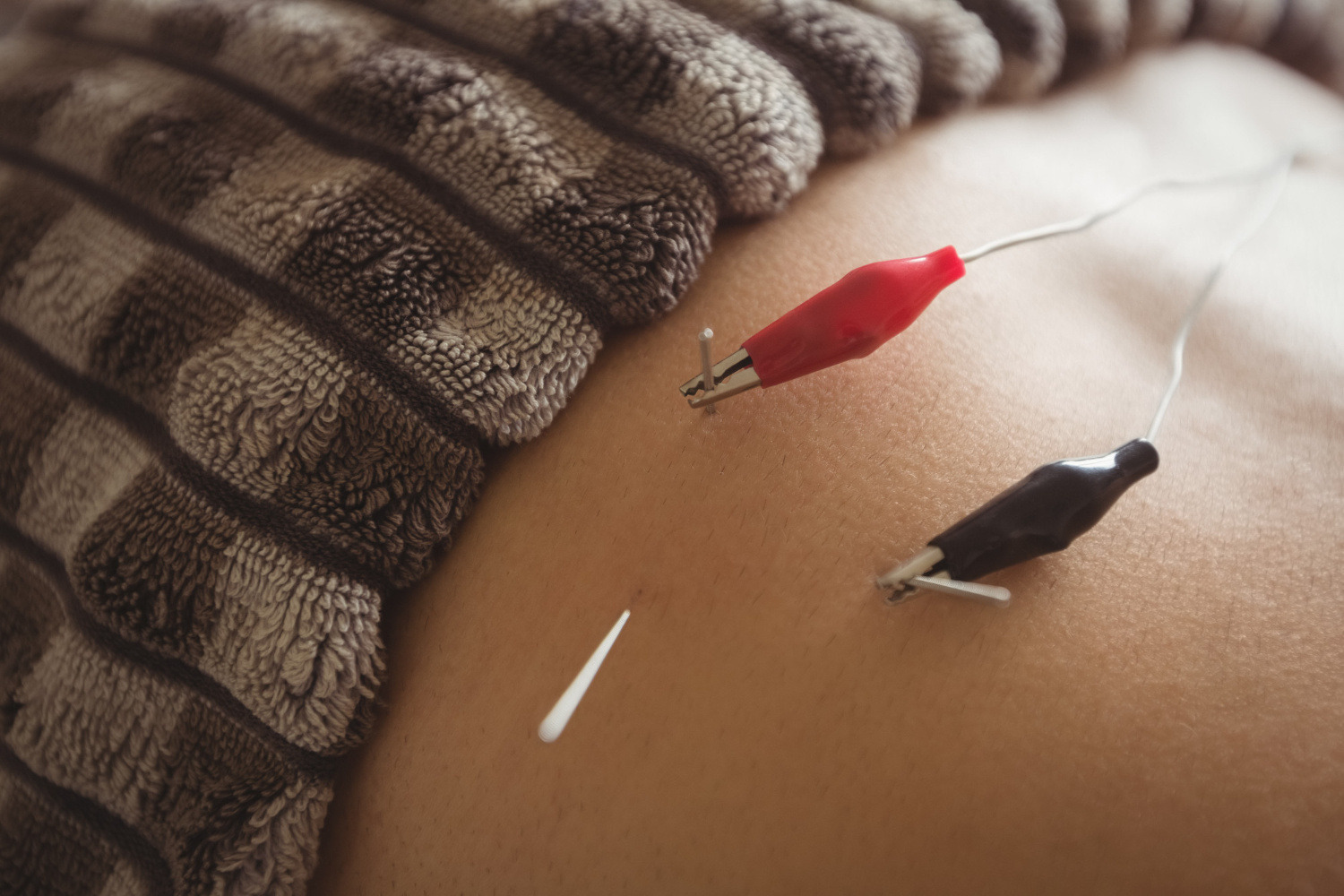 Acupuncture for fertility session at Pinnacle of Wholeness Clinic and Spa in Nigeria